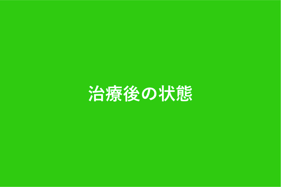 Sample – 30代女性・前歯のガタつきと口元の突出感を改善したマウスピース矯正症例の治療後の状態の画像