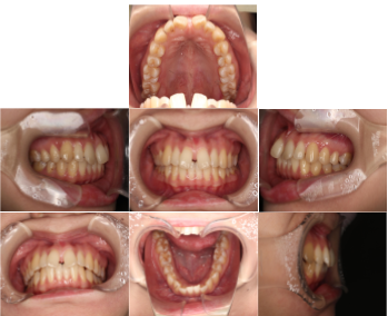 インビザラインによる、前歯のすきっ歯矯正。治療前
