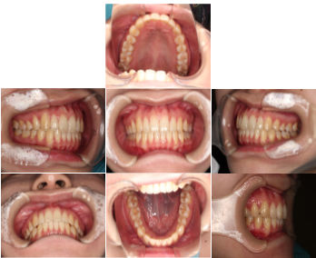 インビザラインによる、前歯のすきっ歯矯正。治療後