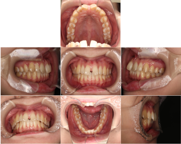 インビザラインによる、前歯のすきっ歯矯正。治療前