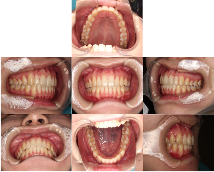 インビザラインによる、前歯のすきっ歯矯正。治療後