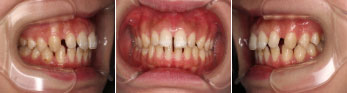インビザラインによる、全体的なすきっ歯矯正。治療前