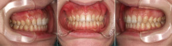 インビザラインによる、全体的なすきっ歯矯正。治療後