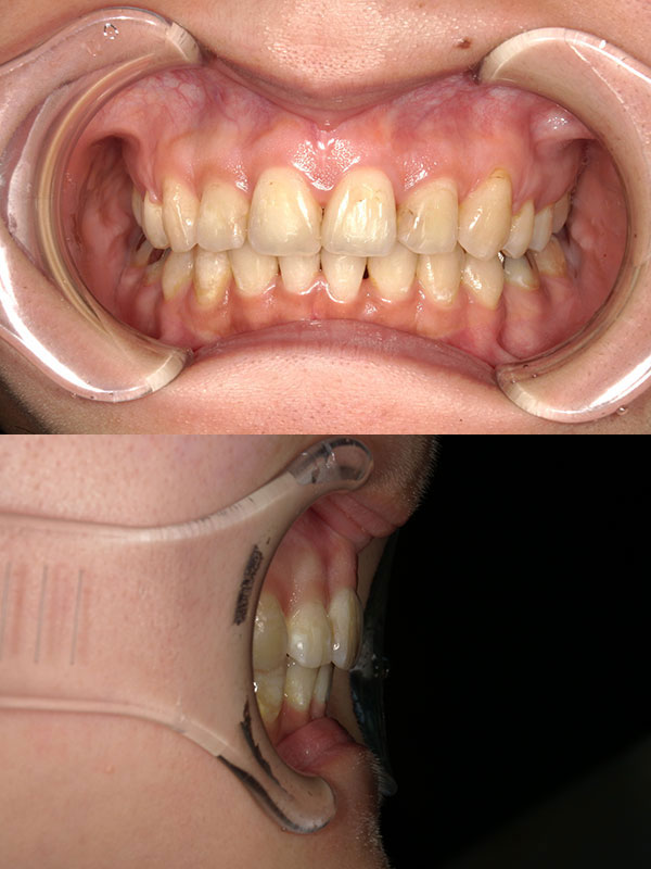 表側矯正(セラミックブラケット)による、上下の前歯のガタガタ・出っ歯・ディープバイト矯正。治療後