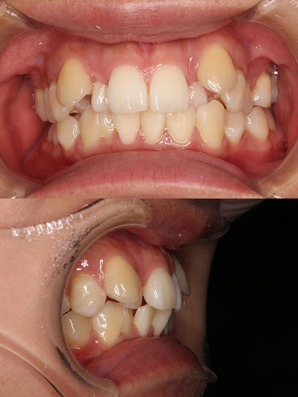 第一小臼歯抜歯・表側矯正による、前歯のガタガタと過蓋咬合（ディープバイト）矯正。治療前