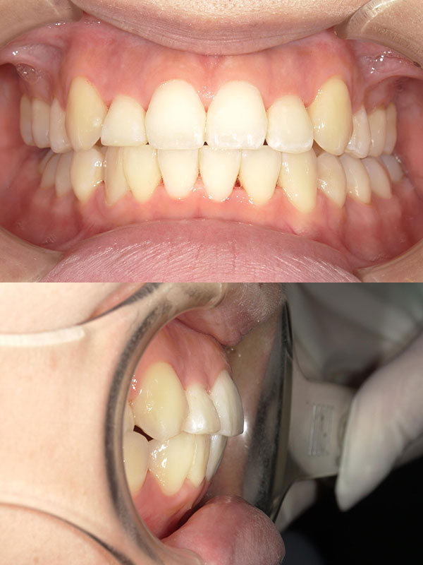 第一小臼歯抜歯・表側矯正による、前歯のガタガタと過蓋咬合（ディープバイト）矯正。治療後