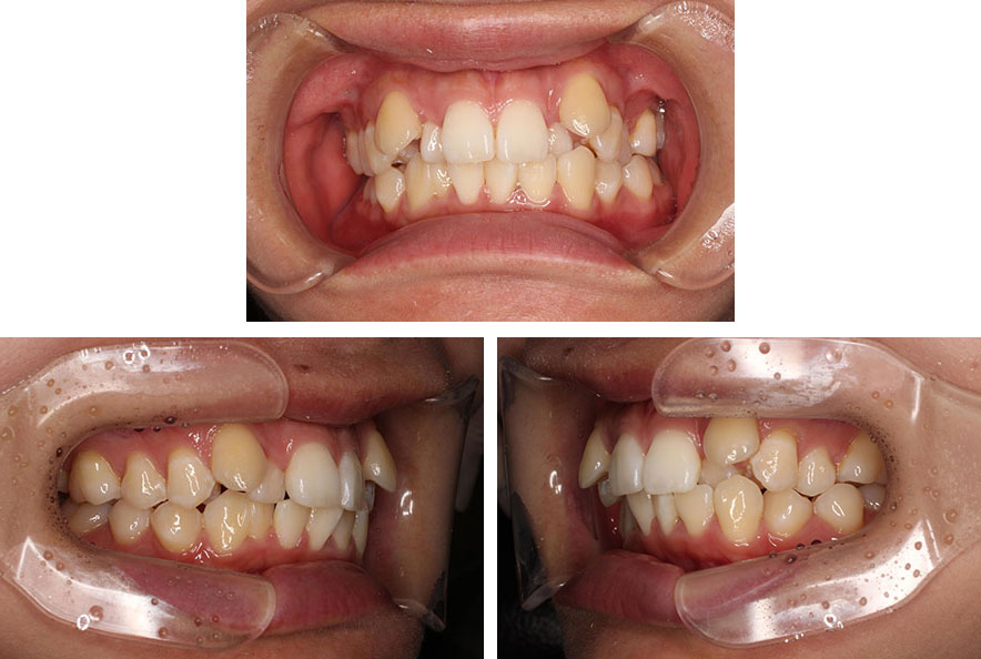第一小臼歯抜歯・表側矯正による、前歯のガタガタと過蓋咬合（ディープバイト）矯正。治療前
