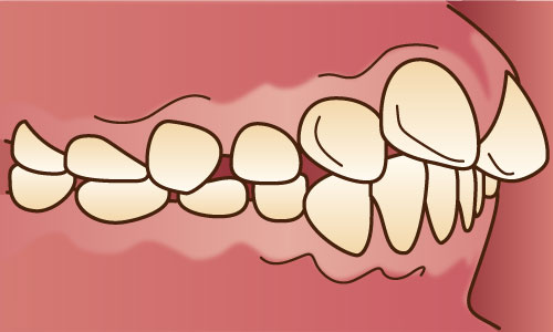 出っ歯の側面図