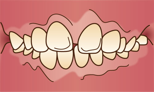 出っ歯の正面図