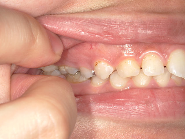 右側の歯のお写真