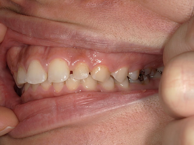 左側の歯のお写真
