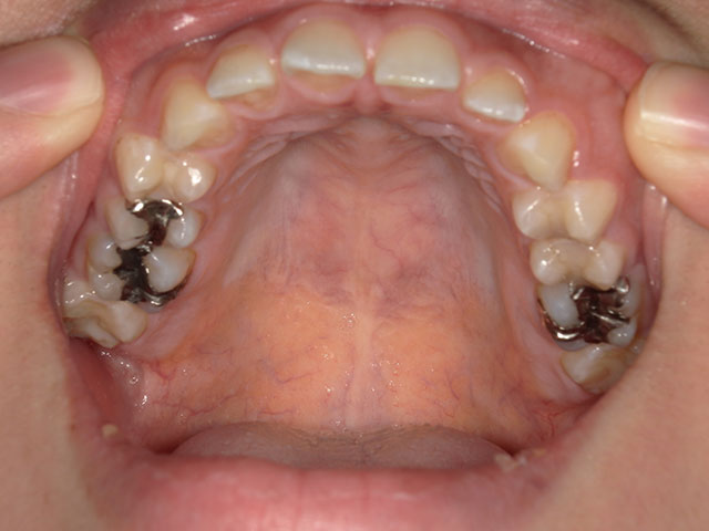 上顎の歯のお写真