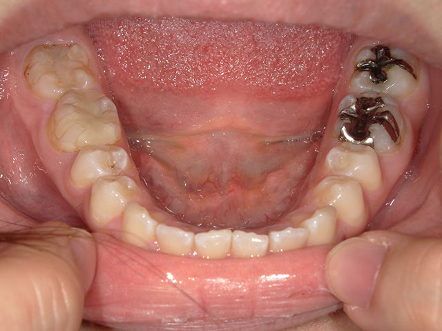 下顎の歯のお写真